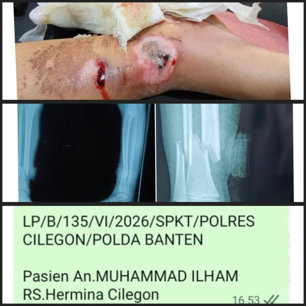 Keluarga Muhammad Ilham (6), bocah yang mengalami patah tulang pada kaki kanan akibat kecelakaan lalu lintas. FOTO: Budi05/PORTALBMI.ID