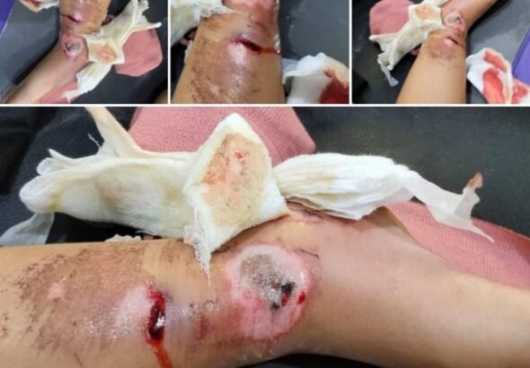 Keluarga Muhammad Ilham (6), bocah yang mengalami patah tulang pada kaki kanan akibat kecelakaan lalu lintas. FOTO: Budi05/PORTALBMI.ID