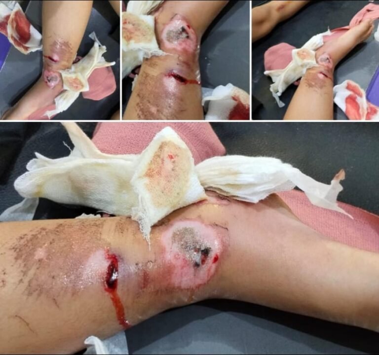 Keluarga Muhammad Ilham (6), bocah yang mengalami patah tulang pada kaki kanan akibat kecelakaan lalu lintas. FOTO: Budi05/PORTALBMI.ID